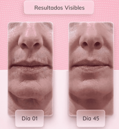 MASAJEADOR FACIAL ADELGAZANTE